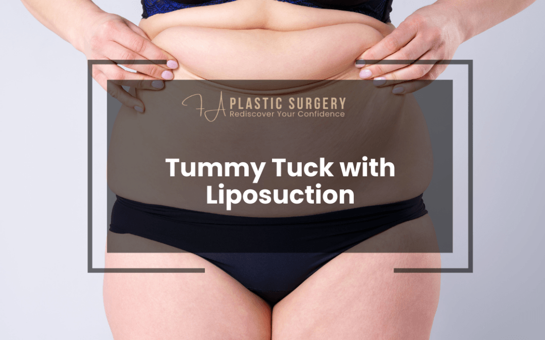 Tummy Tuck with Liposuction