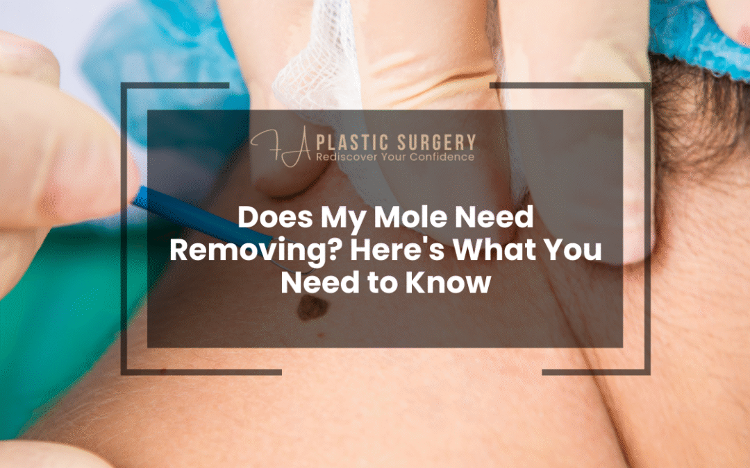Does My Mole Need Removing? Here’s What You Need to Know